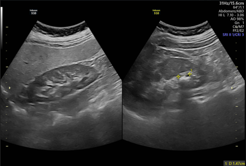 Hình ảnh siêu âm cho thấy sỏi niệu quản ở bệnh nhân