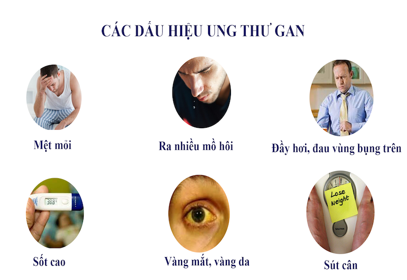 Các triệu chứng ngầm cảnh báo ung thư gan người bệnh cần hết sức lưu ý