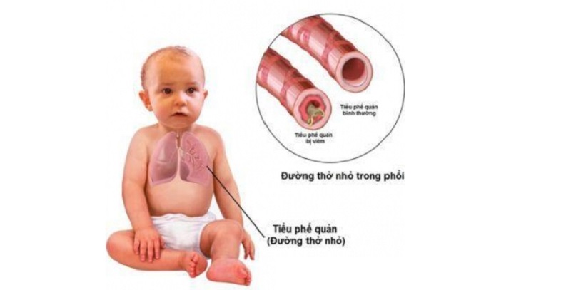 Viêm tiểu phế quản thường xảy ra ở trẻ dưới 2 tuổi