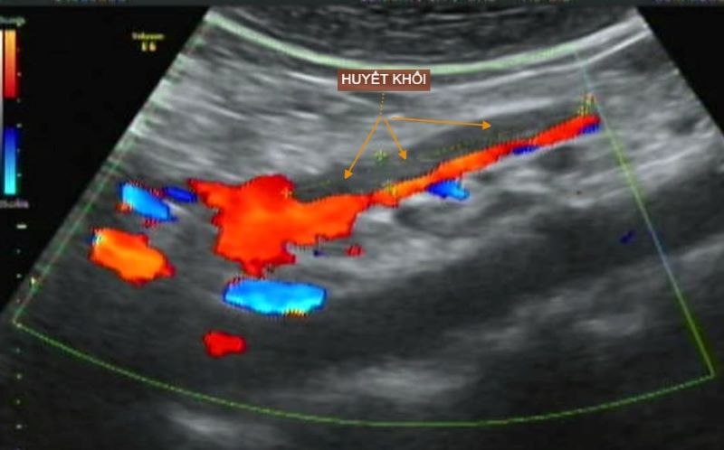 Hình ảnh siêu âm phát hiện vị trí của động mạch mạc treo tràng trên có hình ảnh huyết khối giảm âm, gây hẹp đường kính lòng mạch 