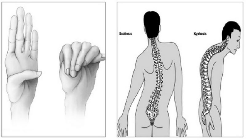 Hình ảnh minh họa tổn thương xương của người mắc hội chứng Marfan