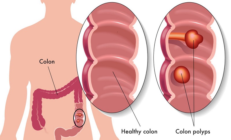 Polyp đại tràng được hình thành do sự tăng sinh bất thường của niêm mạc đại tràng
