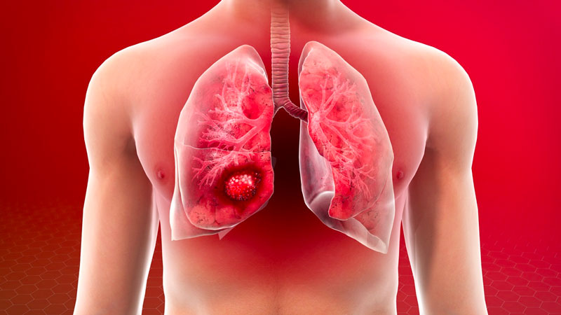 Các loại bệnh phổi thường gặp