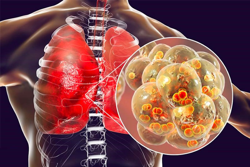 Viêm phổi thùy thường do vi khuẩn phế cầu gây ra