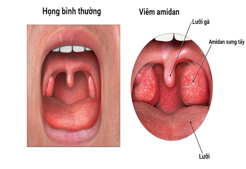 Mô phỏng tình trạng viêm amidan