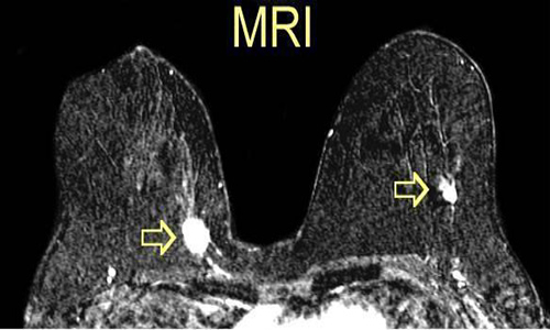 Phát hiện tổn thương bất thường ở vú phải sau khu chụp cộng hưởng từ vú