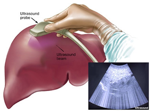 siêu âm gan đặc biệt quan trọng trong chẩn đoán bệnh lý về gan