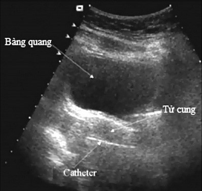 siêu âm tử cung giúp hỗ trợ phát hiện các bệnh lý ở cơ quan sinh dục nữ