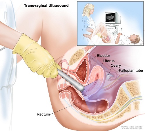 siêu âm đầu dò là một trong những kỹ thuật giúp siêu âm tử cung tốt nhất