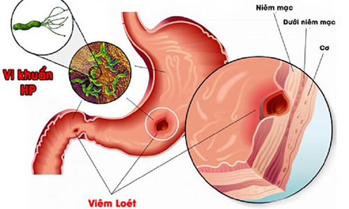 viêm loét dạ dày do vi khuẩn HP, do đó cần xét nghiệm vi khuẩn HP