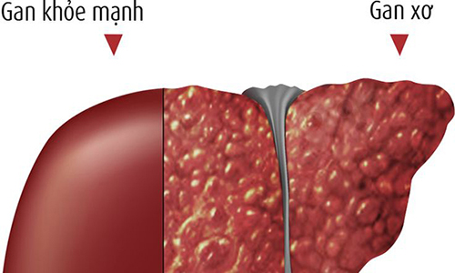 xét nghiệm xơ gan giúp phát hiện các bệnh lý về gan