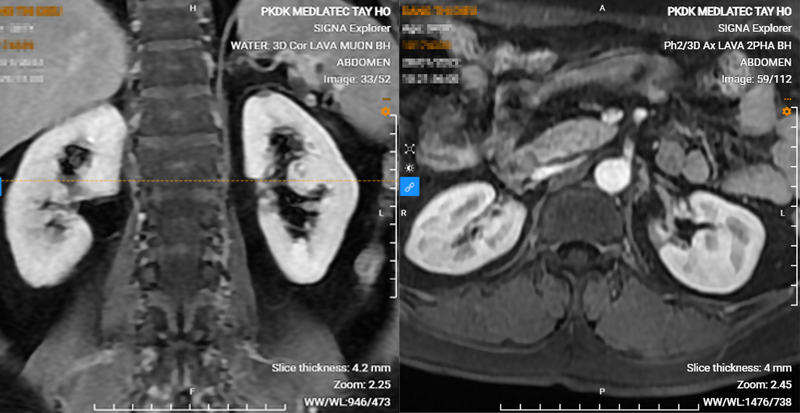 Ảnh trái: MRI tiêm thuốc tương phản khối ngấm thuốc các thì tương đương vỏ thận. Ảnh trái: Hình ảnh phì đại trụ Bertin của bệnh nhân khi chụp trên phim chụp MRI