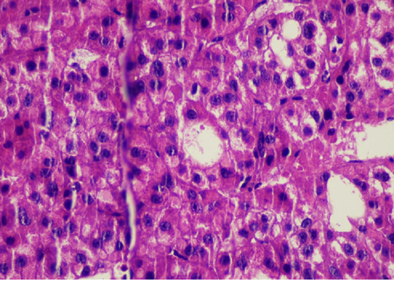 Kết quả giải phẫu bệnh có hình ảnh Carcinoma tế bào gan biệt hoá vừa