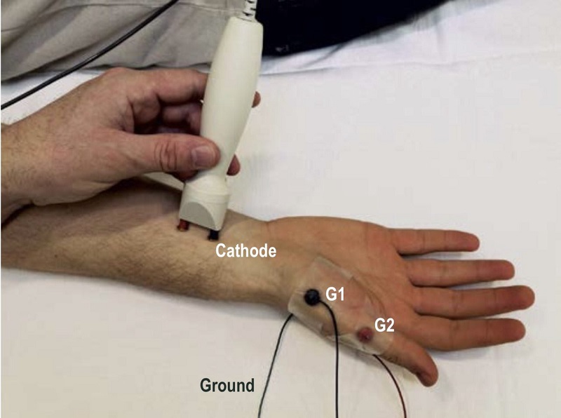 Khảo sát điện thần kinh - cơ được xem là tiêu chuẩn “vàng” chẩn đoán hội chứng ống cổ tay