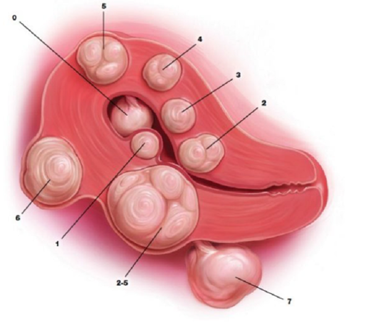 Cách phân loại u xơ cơ tử cung theo FIGO 