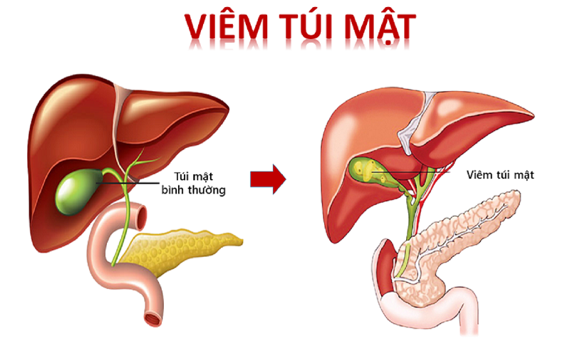 Viêm túi mật nếu không được điều trị kịp thời có thể gây hoại tử thủng nên cần phải can thiệp bằng phẫu thuật cấp cứu