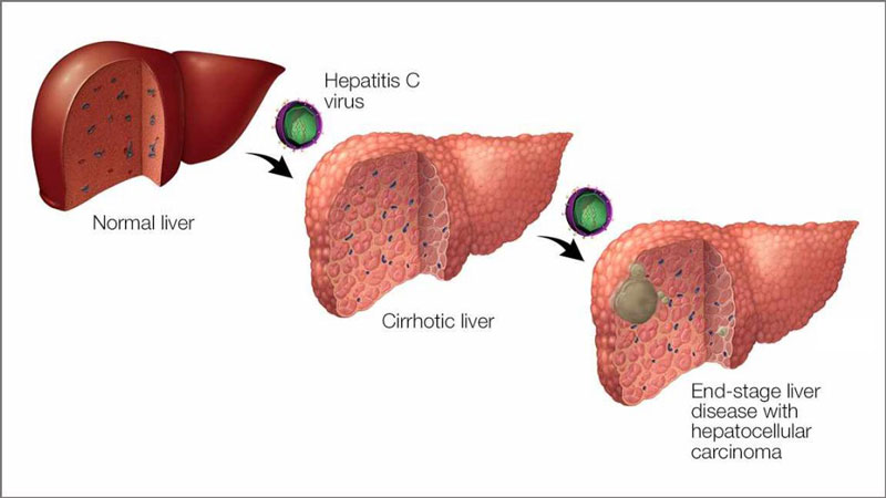 Bệnh viêm gan C là căn bệnh về gan gây ra bởi Hepatitis C Virus 