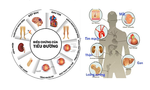 Bệnh lý đái tháo đường gây nhiều biến chứng nguy hiểm