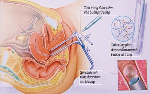 Phương pháp bơm tinh trùng vào tử cung (IUI) là gì? | Medlatec