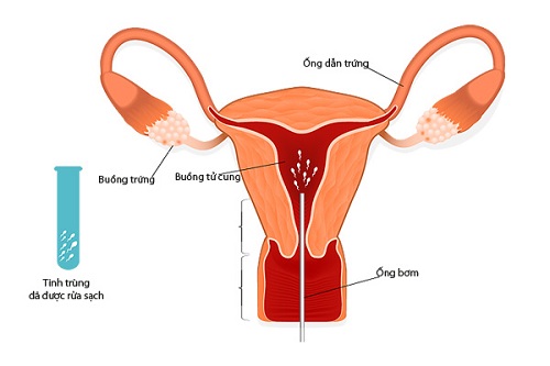 Thực hiện bơm tinh trùng vào tử cung