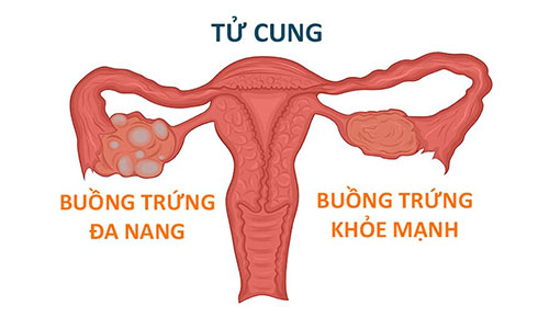 Buồng trứng đa nang là lý do gây nên vô sinh hiếm muộn ở nữ giới