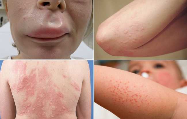 Các nguyên nhân gây dị ứng