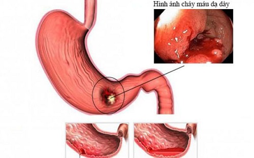 Chảy máu đường tiêu hóa