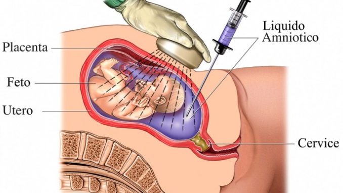 Chọc ối có ý nghĩa quan trọng trong chẩn đoán trước sinh