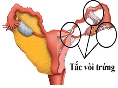 phụ nữ bị tắc vòi trứng cần đi chữa vô sinh hiếm muộn