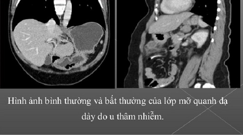 Chụp cát lớp dạ dày tại MEDLATEC an toàn, nhanh chóng, chính xác