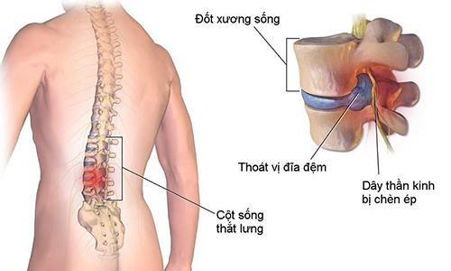 chụp cộng hưởng từ cột sống là phương pháp chẩn đoán hình ảnh hiện đại nhất hiện nay