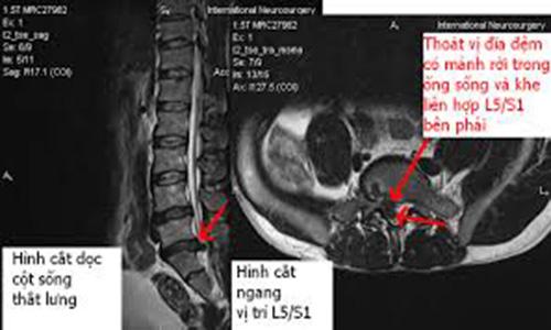 Hình ảnh tổn thương cột sống được thu lại từ chụp cộng hưởng từ