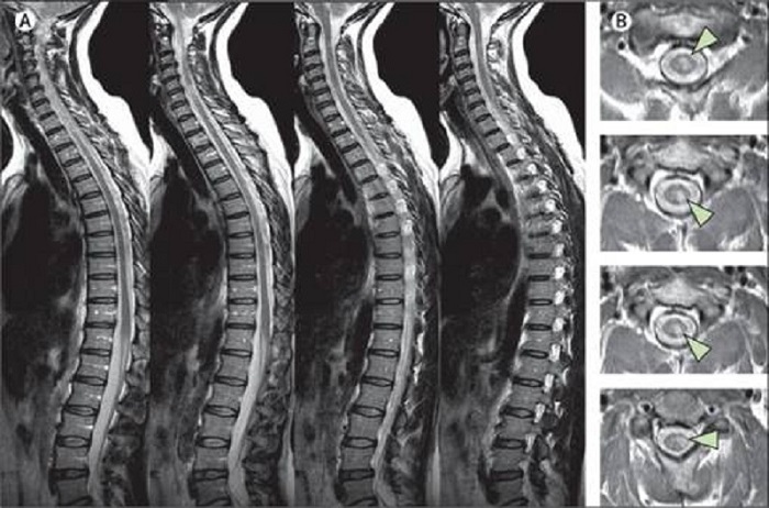 Hình ảnh chi tiết thu được sau khi chụp cộng hưởng từ cột sống thắt lưng