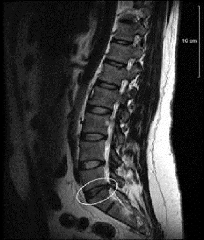 Phát hiện thoát vị đĩa đệm nhờ chụp MRI