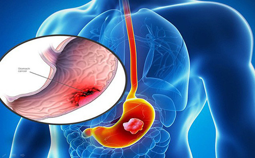 Chụp CT dạ dày giúp phát hiện những bất thường về bệnh lý ở dạ dày