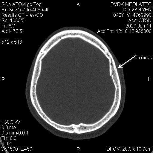 Một hình ảnh kết quả chụp CT não hiện nay