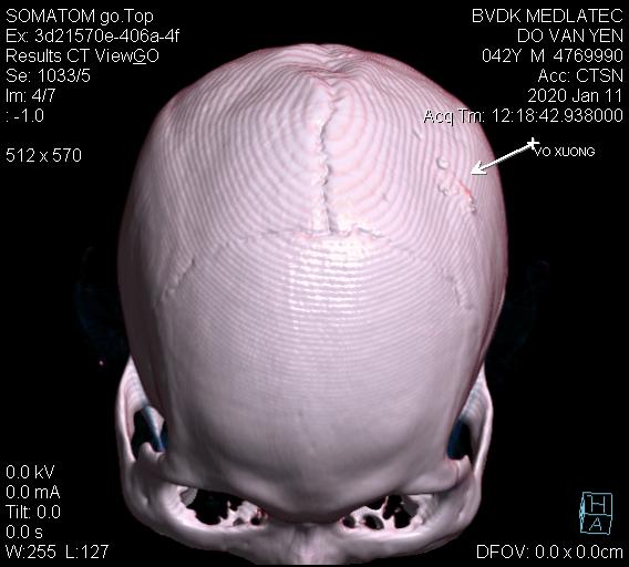 Chụp CT não giúp hỗ trợ tái tạo cấu trúc của hộp sọ và mô não thành hình ảnh trực quan một cách chi tiết và chính xác nhất