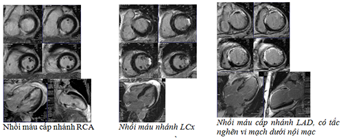 Phát hiện nhồi máu cấp qua hình ảnh chụp MRI tim