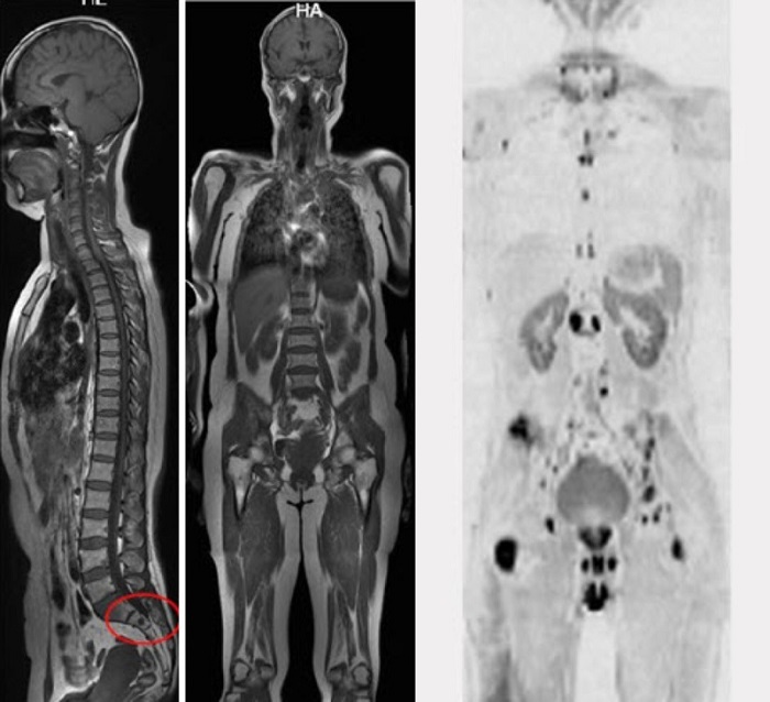 Hình ảnh bệnh nhân chụp MRI toàn thân