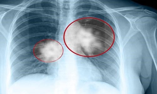 Chụp X-quang tim phổi và những điều cần biết