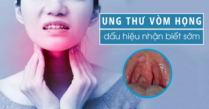 Dấu hiệu của ung thư vòm họng