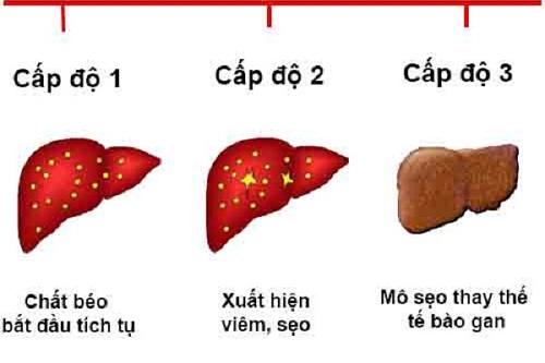 Người bị gan nhiễm mỡ độ 3 nên ăn gì để kiểm soát bệnh tốt?