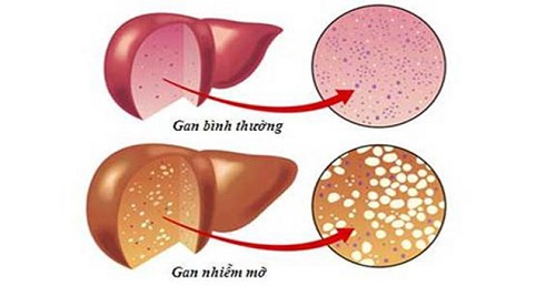 Người bị gan nhiễm mỡ độ 3 nên ăn gì để kiểm soát bệnh tốt?