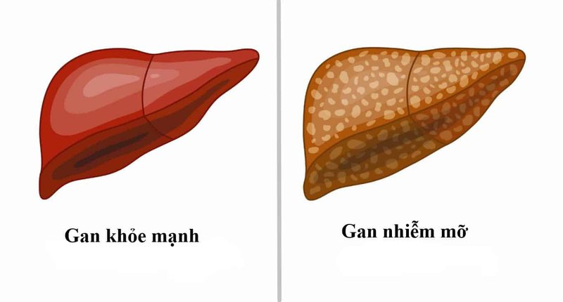 Gan nhiễm mỡ nên sử dụng thuốc có thành phần như acid amin