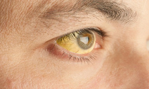 Nếu thấy vàng mắt nên đi khám vì đây là dấu hiệu của bệnh gan nhiễm mỡ