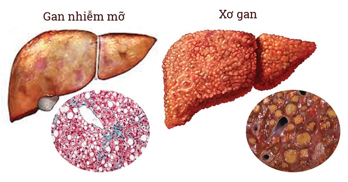 Gan nhiễm mỡ độ 3 có nguy hiểm hay không