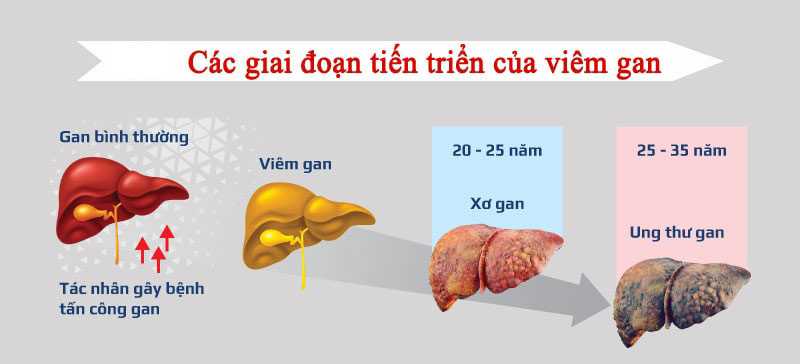 Giai đoạn tiến triển của bệnh viêm gan B