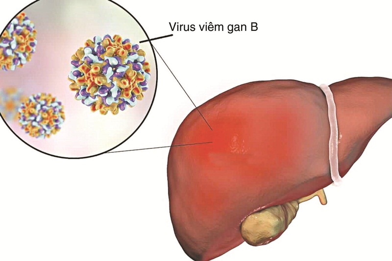 Rất nhiều người Việt đang phải đối mặt với bệnh viêm gan B