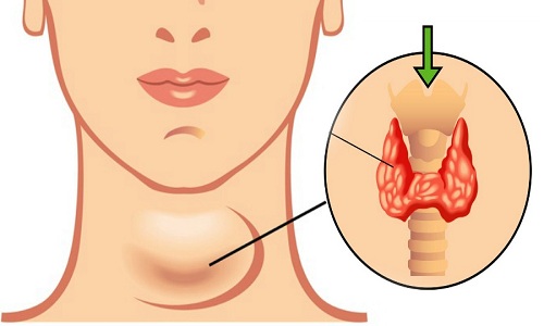 Đốt sóng cao tần - điều trị u tuyến giáp lành tính không cần phẫu thuật tại MEDLATEC