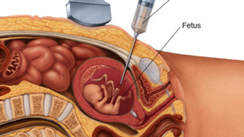 Cần thận trọng khi xét nghiệm chọc dịch ối